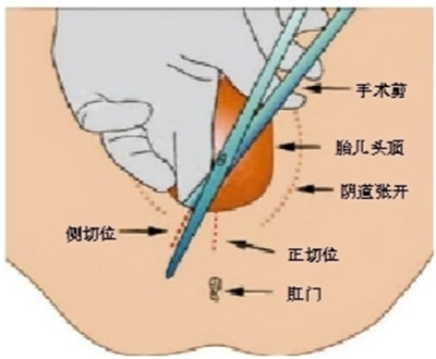 側切是什么意思2