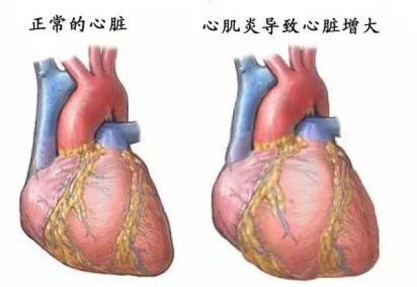 29歲年輕媽媽發(fā)病一周后死亡，這種病常盯上身體好壓力大的青壯年